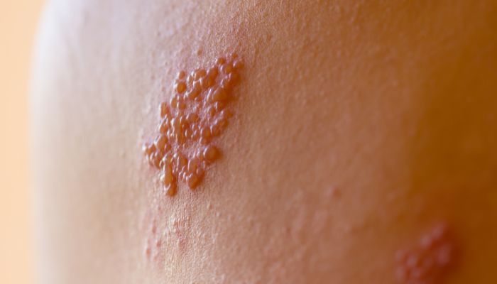 Mụn rộp sinh dục