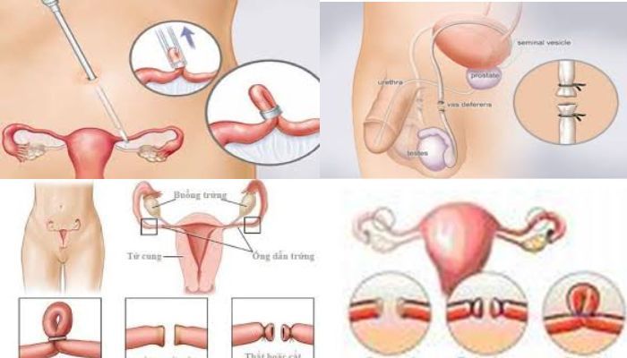Tránh thai vĩnh viễn
